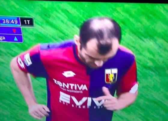 What kind of a balding pattern is this ?