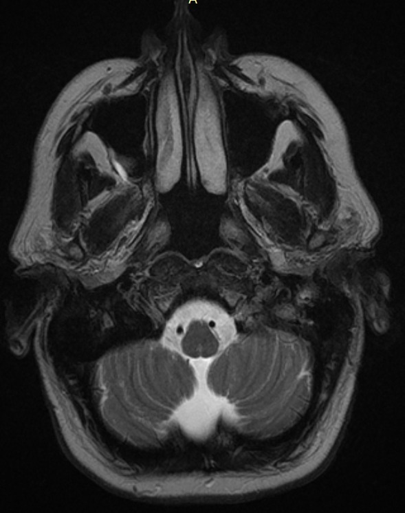 For years I thought I had depressions. But recently I found out that it is just because of this sad duck, that lives, where my brain is supposed to be!