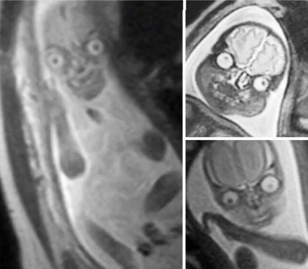 The reason why pregnant people get ultrasounds and not MRIs, is that in an MRI, this is what a fetus looks like