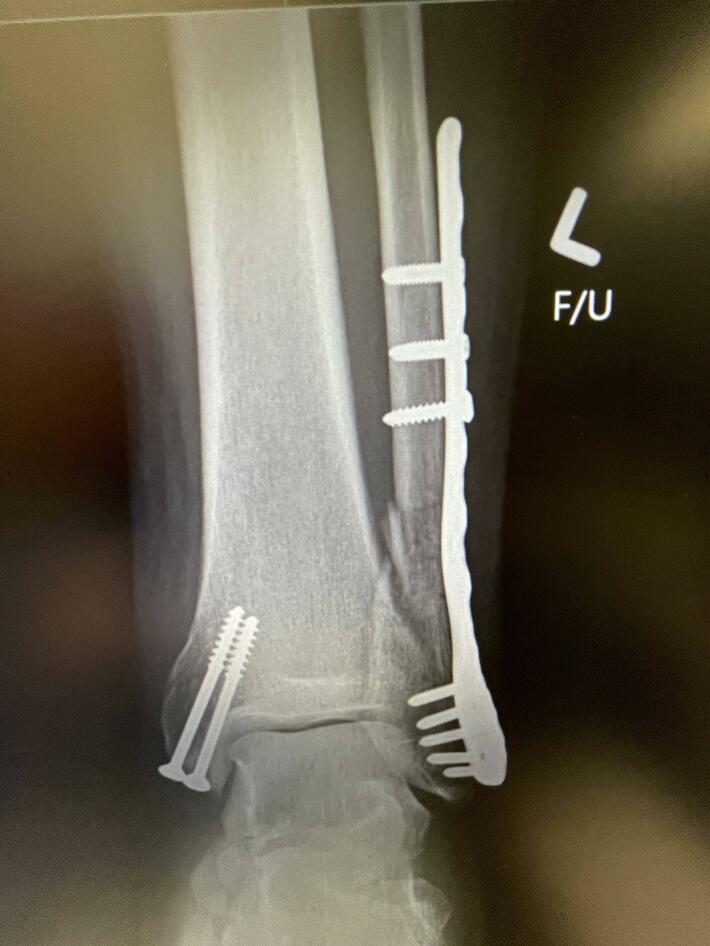 I broke my ankle and the surgeon left his toothbrush in my leg