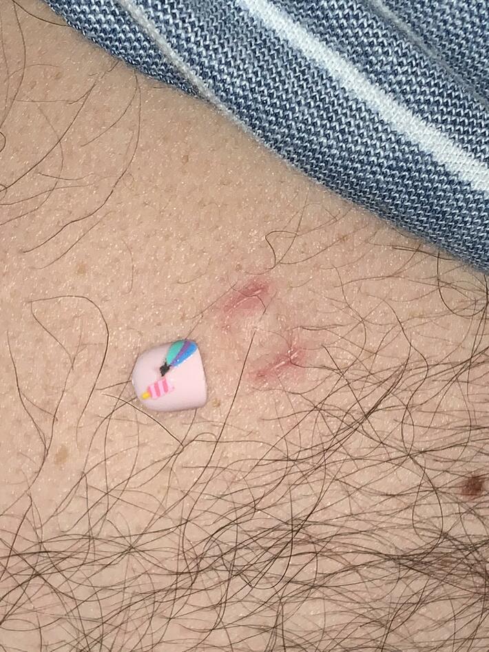 Felt something on husbands back, turned out to be fake stick on nail our 4 year old had over 2 days ago, said it’s been hurting! 😂