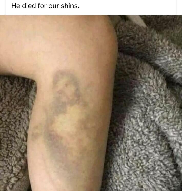 Bless be the contusion.